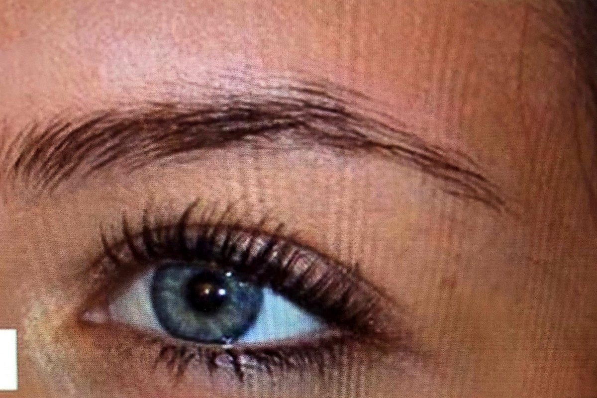 Brow before treatment, closed eye